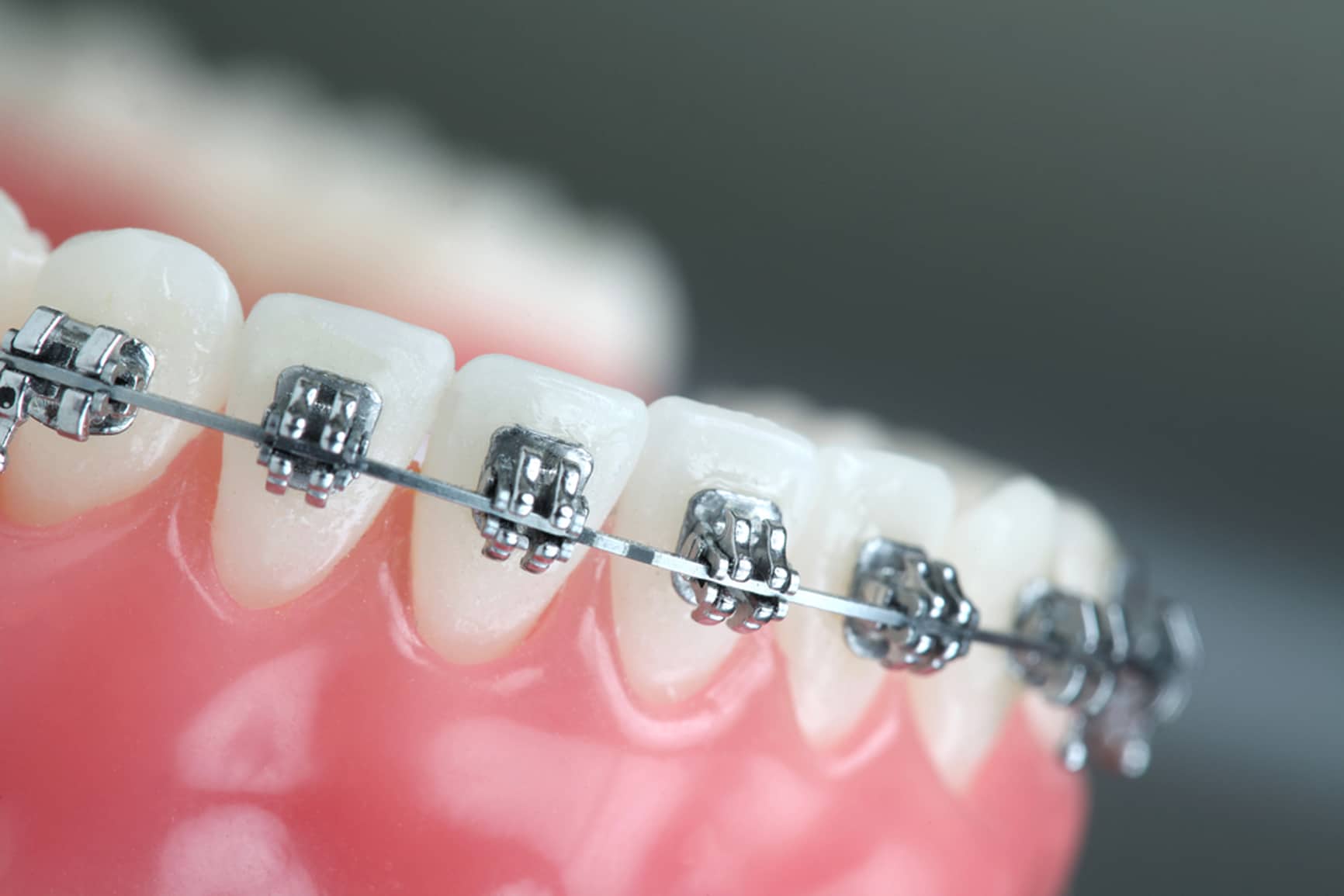 Orthodontics in Draper, West Jordan, UT. Dr. Willard Zurcher. Zurcher Orthodontics