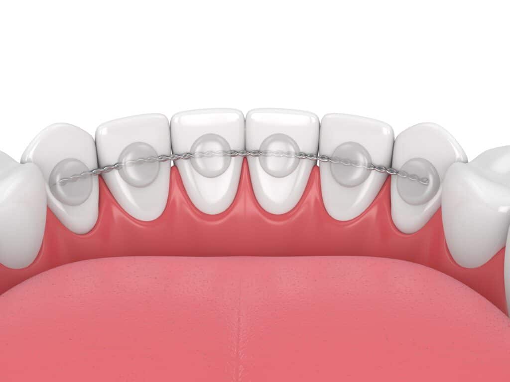 Bonded Permanent Retainers in Draper, West Jordan, UT. Dr. Willard Zurcher. Zurcher Orthodontics