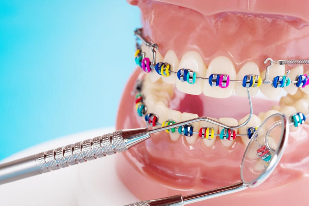 Orthodontic Care: 5 Tips for Maintaining Oral Hygiene While Wearing Braces in Draper, West Jordan, UT. Dr. Willard Zurcher. Zurcher Orthodontics