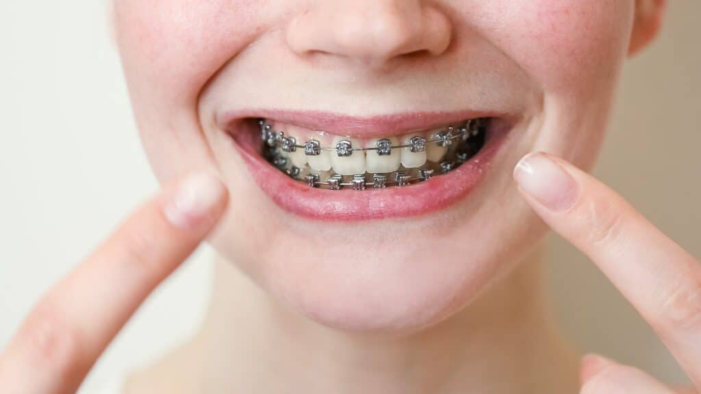 Traditional Braces in Draper, West Jordan, UT. Dr. Willard Zurcher. Zurcher Orthodontics