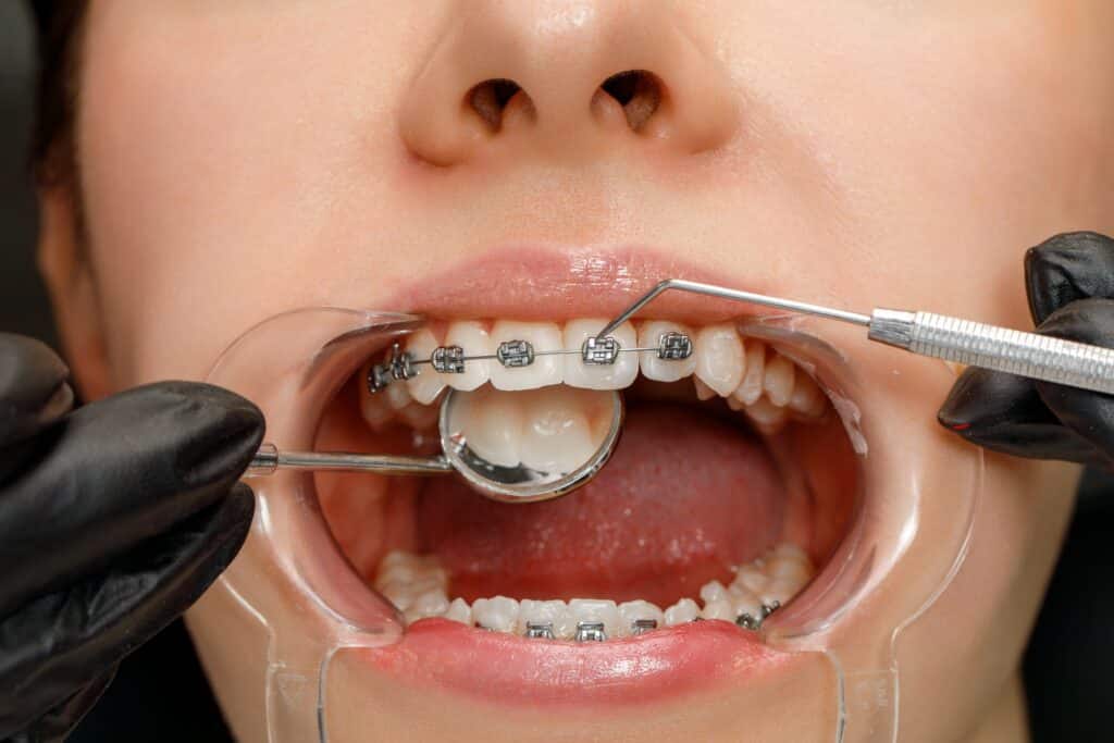 Orthodontic Adjustments Draper and West Jordan